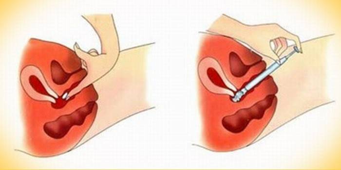 Supositorio vaginal