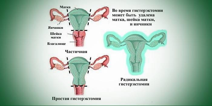 Jednoduchá a radikálna hysterektómia maternice