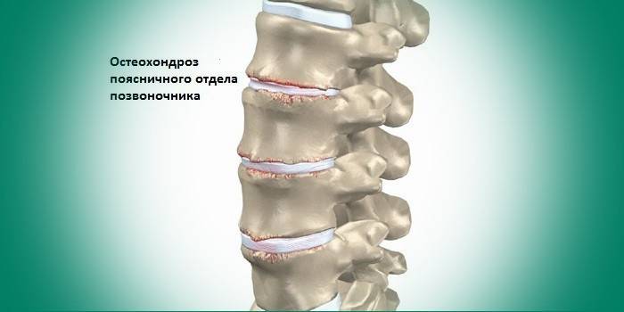 Osteocondrosis de la zona lumbar.