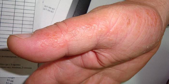 Eczema dishidrótico