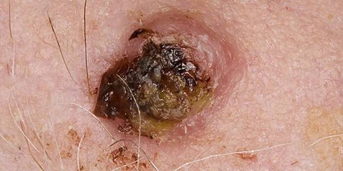 Cáncer de piel de células basales