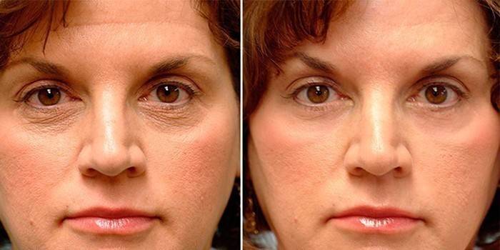 Reducción de arrugas faciales por microcorrientes