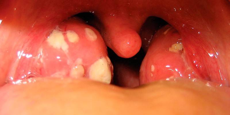 Infecção por amígdala estreptocócica