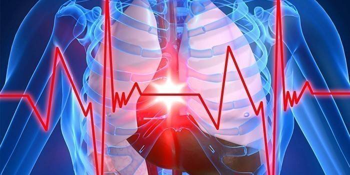 Angina pectoris