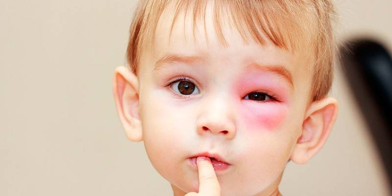 Picadura de insecto en un niño