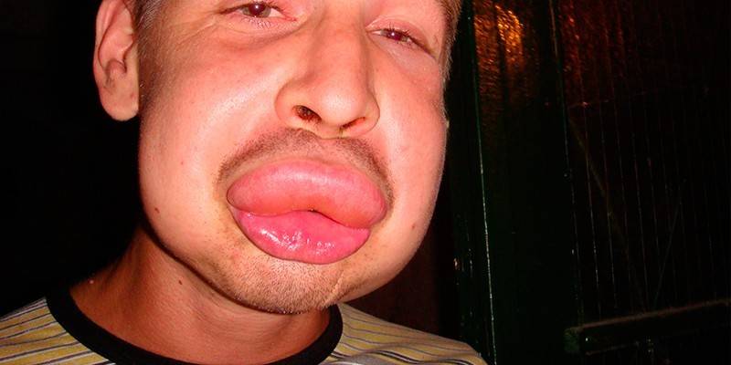 Labios después de una picadura de abejorro