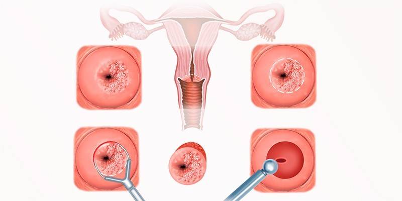 Remoção de erosão cervical