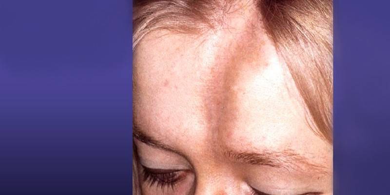 Esclerodermia linear no rosto de uma mulher