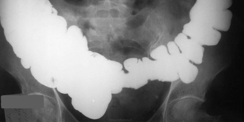 Obstrução intestinal