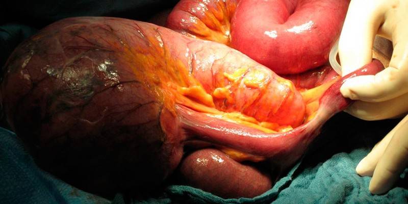 Obstrucción intestinal