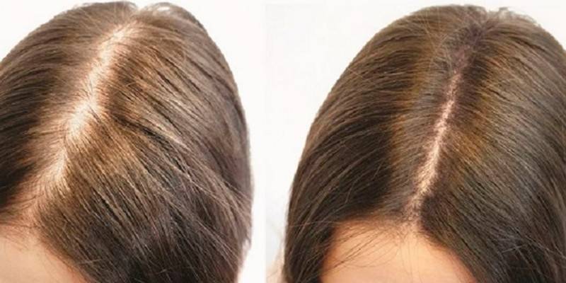 El efecto de la caída del cabello.