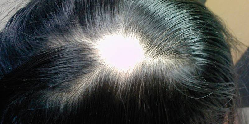 Pequena careca