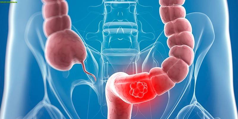 Cáncer de intestino