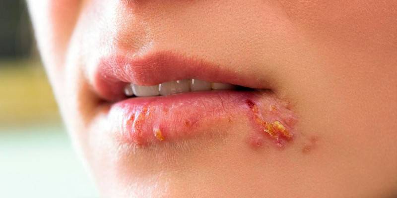 Herpes no lábio