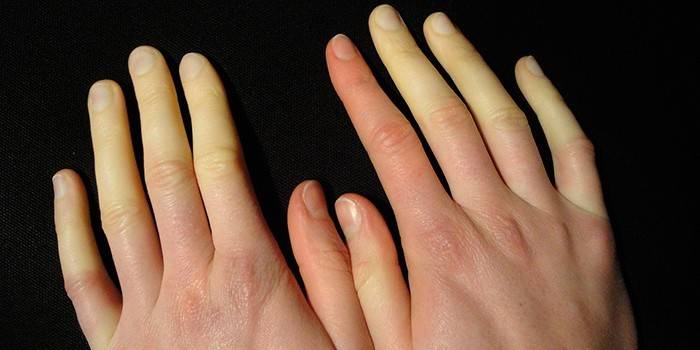 Doença de Raynaud