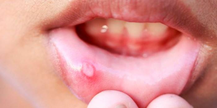 Stomatitis