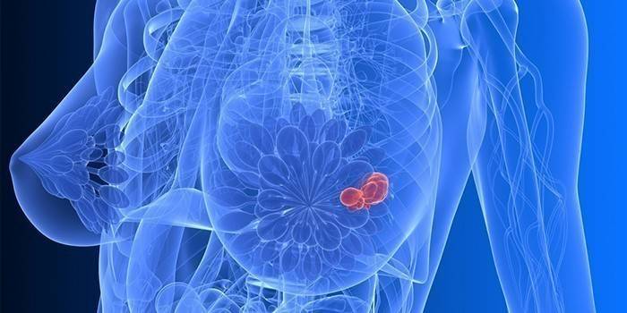 Cáncer de mama