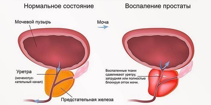 Zapalenie gruczołu krokowego