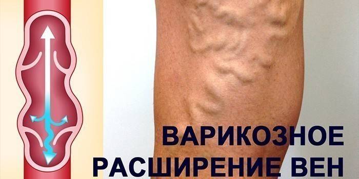 Варикозне вене