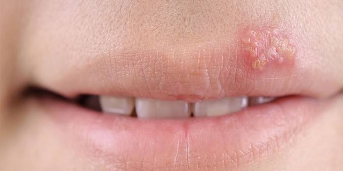 manifestação do vírus do herpes no lábio superior