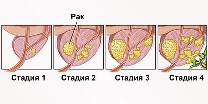 Etapy raka prostaty