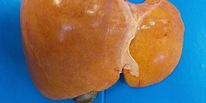Hígado afectado por hepatosis grasa