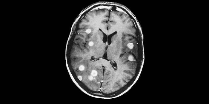 Metástases cerebrais