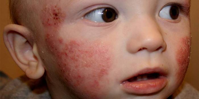 Herpes simplex na pokožke tváre dieťaťa