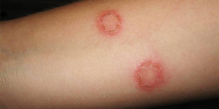 microsporia