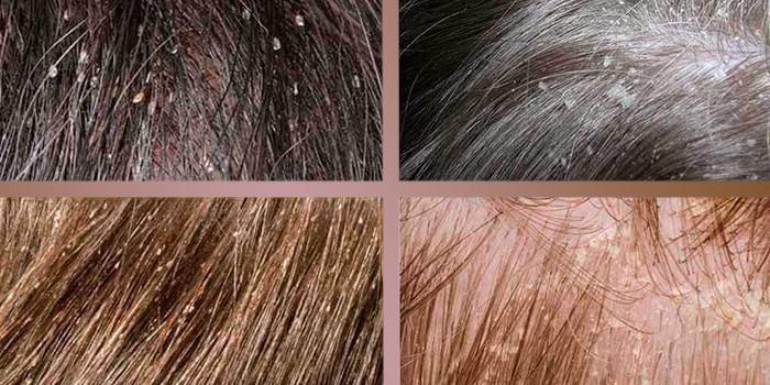 Liendres en el cabello