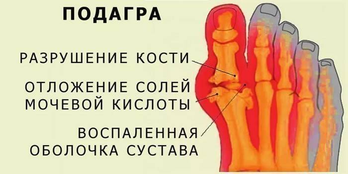 Objawy dny moczanowej