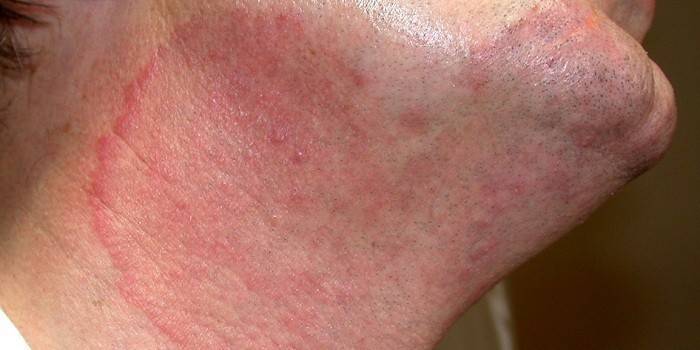 Dermatofytóza na krku človeka