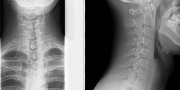 Raio X da coluna cervical