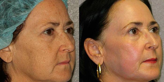 Antes y después del curso de la terapia.