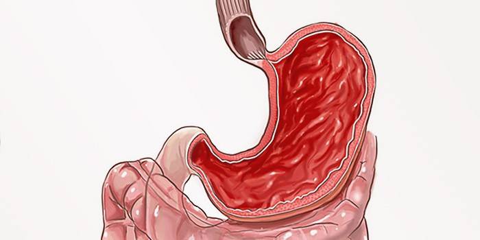Gastritis en el esquema