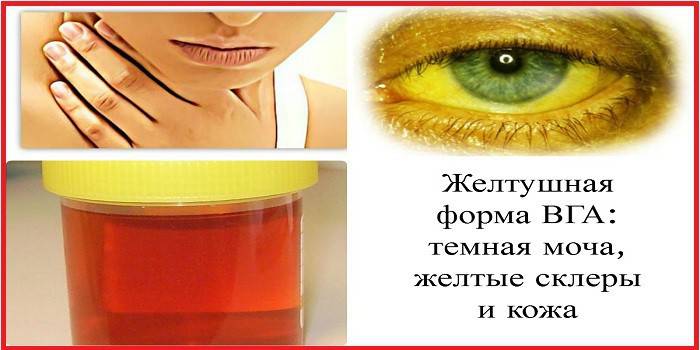 Príznaky hepatitídy A