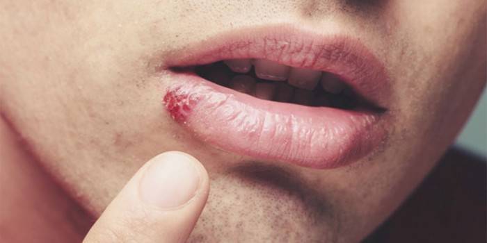 Sintoma de um vírus simples em um homem em seu lábio inferior