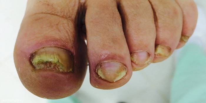 Unhas dos pés afetadas pelo fungo