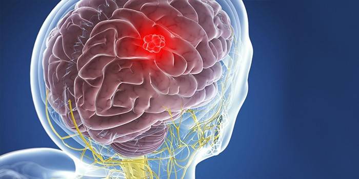 Tumor cerebral
