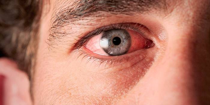 Enrojecimiento de los ojos en un hombre