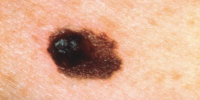 Carcinoma basocelular sólido