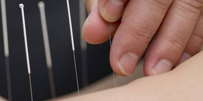 Acupuntura