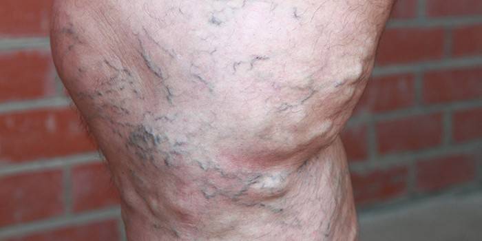 Contra-indicado em veias varicosas