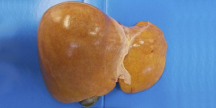 Hepatosis del hígado graso
