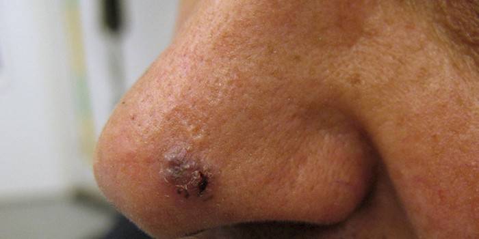 Cáncer de células en la nariz.