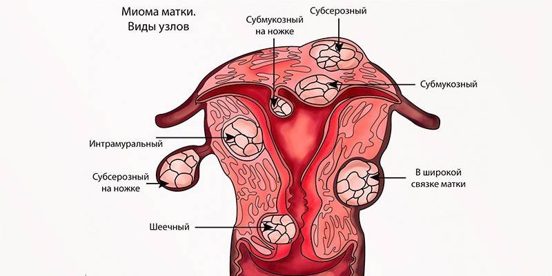 Tipos de miomas
