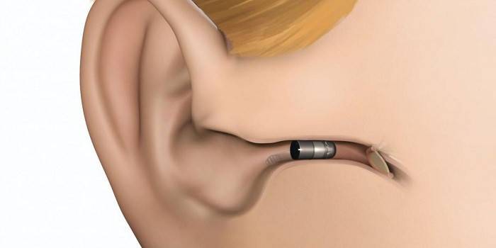El diseño del audífono intrauditivo