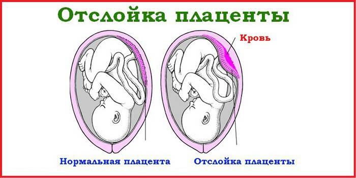 Desprendimiento de placenta