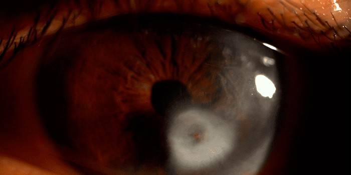 Nubosidad corneal