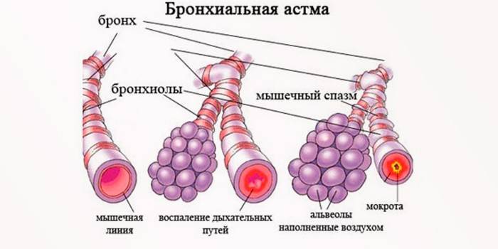 Bronchi s astmou
